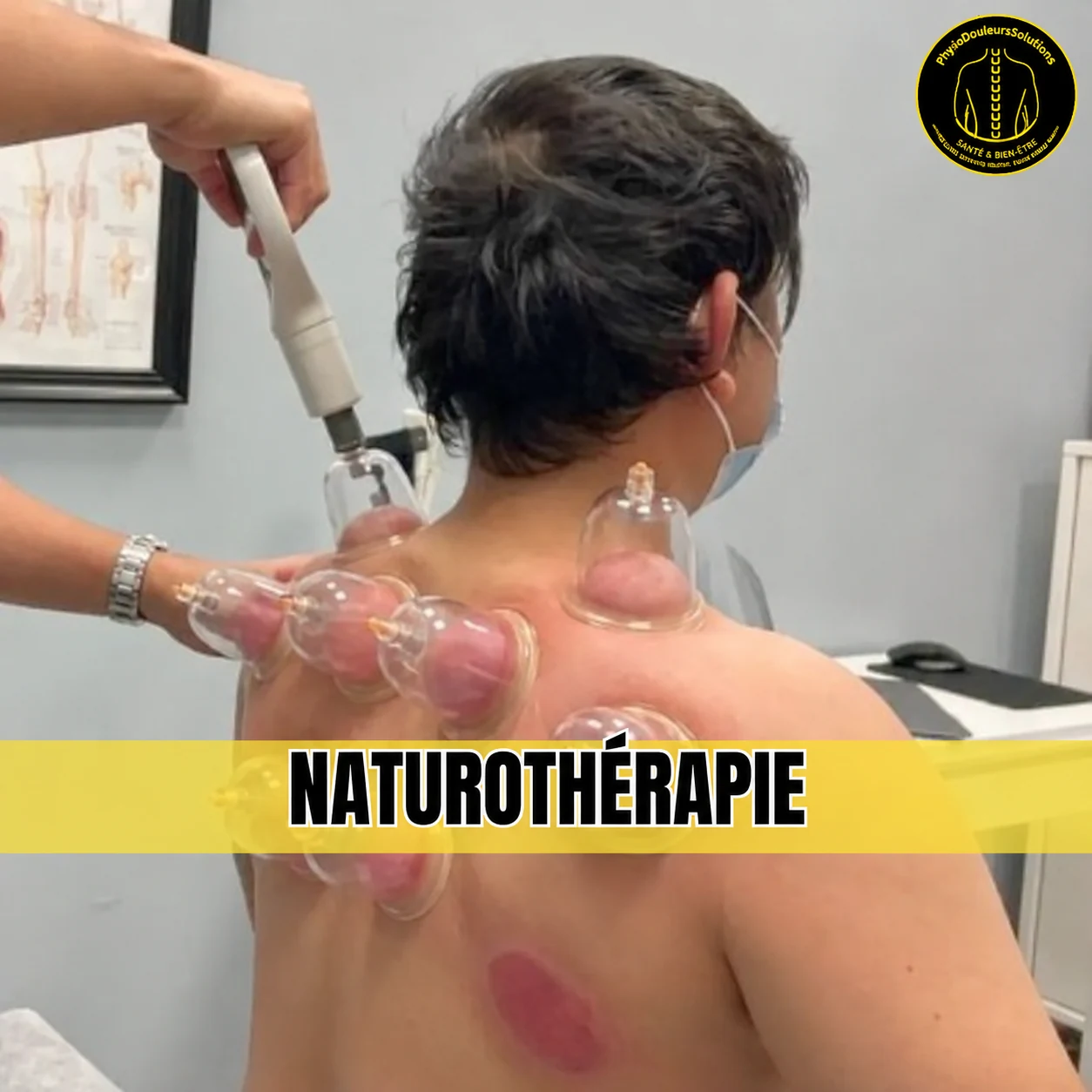 Pose de ventouses sur le haut du dos d'un patient, naturothérapie