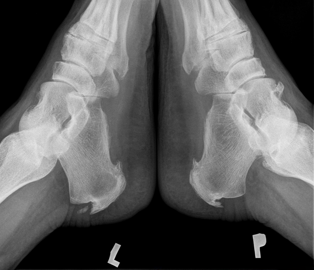 X-ray of a heel showing a calcaneal spur, a small bony growth on the heel bone