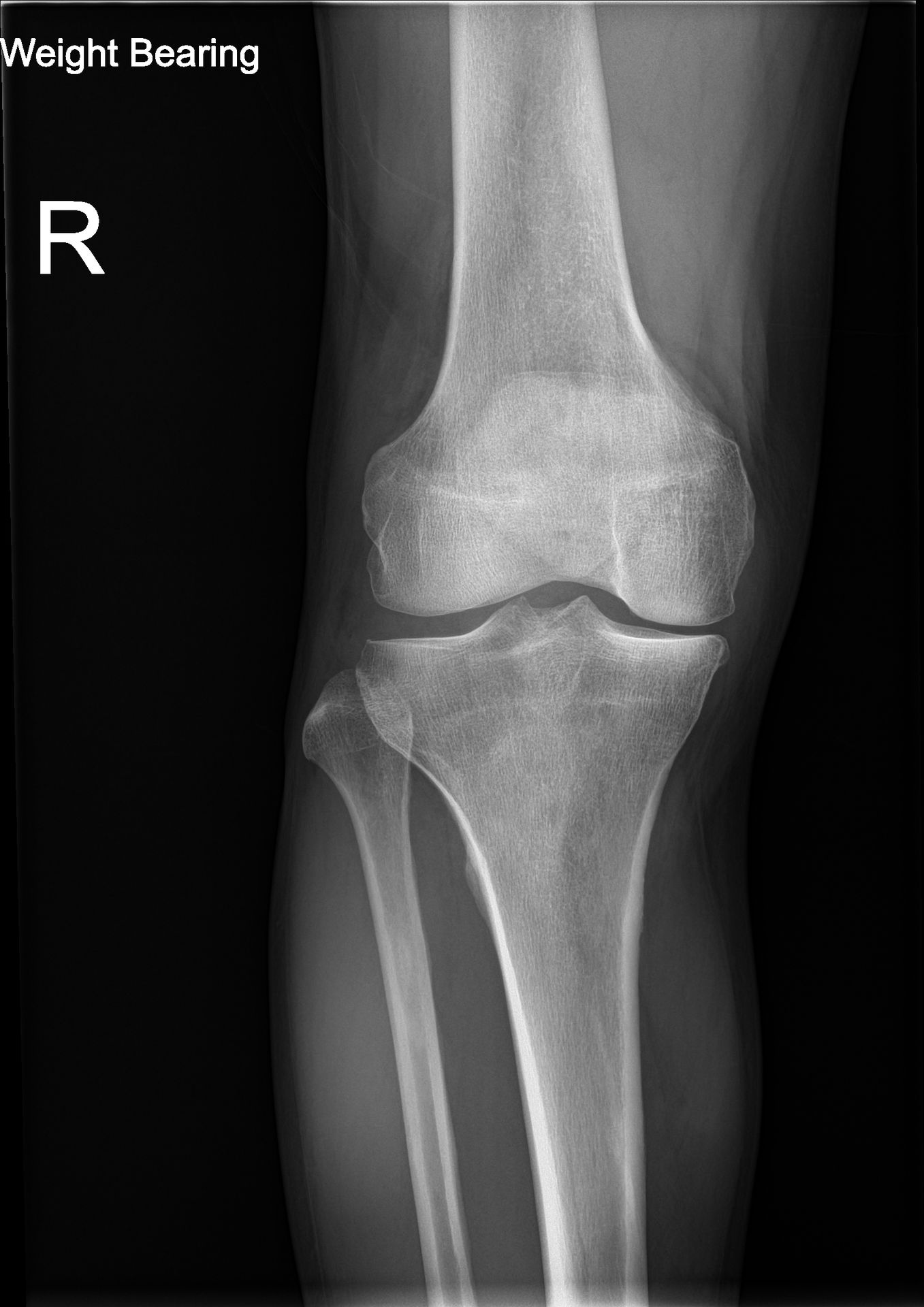 Une radiographie en charge d'un genou droit montrant l'espace articulaire entre l'os de la cuisse et le tibia